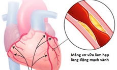 Tim mạch - bệnh lý gây tử vong số một trên thế giới