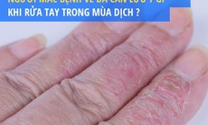 Người mắc bệnh về da cần lưu ý gì khi rửa tay trong mùa dịch?