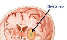 Bệnh u não và thai nghén