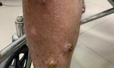 Nguy cơ từ nhóm vi khuẩn không phải lao - Một vấn đề toàn cầu hiện nay