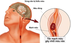 Chớ xem thường rối loạn tuần hoàn não