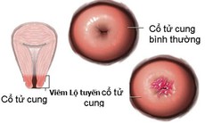 Viêm lộ tuyến cổ tử cung gây ung thư & vô sinh