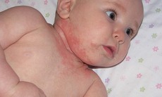 Viêm da dị ứng ở trẻ có nguy hiểm không?