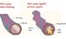 Chữa tận gốc hen suyễn bằng phương pháp cấy chỉ