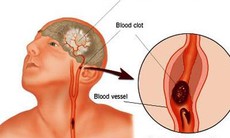 Tai biến mạch máu não – Phòng ngừa và chữa trị 