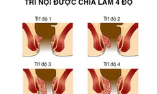 Bệnh Trĩ - Nỗi đau khó nói