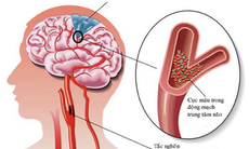 Vai trò của Ginkgo Biloba trong hỗ trợ điều trị tai biến mạch máu não