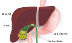 Bị sỏi túi mật có nhất thiết phải mổ?