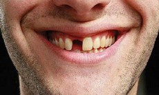 Bị mất răng cửa thì nên trồng răng bằng phương pháp nào thích hợp?