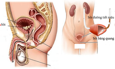 Sỏi bàng quang - Những chú ý không thể bỏ qua