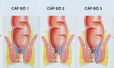 Phương pháp mới đẩy lùi bệnh Trĩ hiệu quả bằng Bào tử lợi khuẩn đã được chứng minh