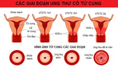 8 câu hỏi giúp phát hiện sớm bệnh về cổ tử cung và ung thư cổ tử cung