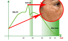 90% phụ nữ không biết cách điều trị nám da do nội tiết như thế nào?