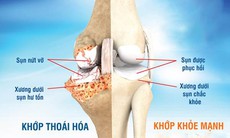 Đi tìm giải pháp tối ưu cải thiện viêm khớp và thoái hóa khớp