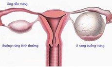 Khắc tinh của bệnh u nang buồng trứng, u xơ tử cung