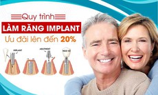 Quy trình làm răng Implant với giá ưu đãi 20%