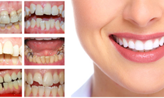 Thẩm mỹ răng sứ - Những lưu ý cần nhớ trước khi thực hiện