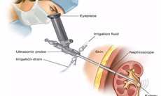 Phương pháp đẩy lùi sỏi thận ít đau, hiệu quả bên cạnh việc tán sỏi