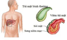 5 sự thật về bệnh sỏi mật không phải ai cũng biết