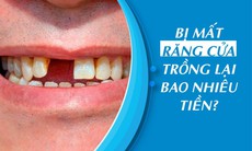 Bị mất răng cửa chi phí trồng lại là bao nhiêu?