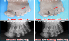 Điều trị hạ axit uric, tan cục tophi, phục hồi xương khớp cho người bị gút