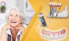 Kỹ thuật cấy implant cho người mất răng toàn hàm