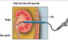 Tán sỏi nội soi qua da - giải pháp tránh mổ mở cho người bị sỏi thận to