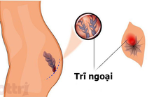 Nguyên nhân, triệu chứng, giải pháp đặc hiệu cho bệnh trĩ ngoại từ thuốc thảo dược