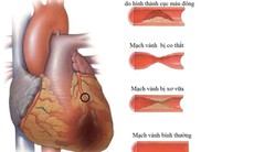 3 nguyên nhân gây thiếu máu cơ tim không phải ai cũng biết