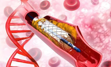 Đặt stent mạch vành - 6 biến chứng người bệnh cần biết và Cách để ngăn ngừa