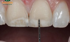 Bạn có đang “hiểu lầm” về phủ răng sứ?