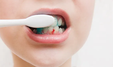 Chảy máu chân răng khi đánh răng – không thể chủ quan