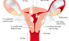 Cách hay giúp cải thiện u xơ tử cung mà không cần phẫu thuật