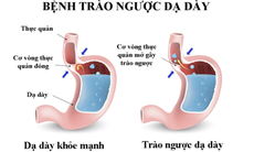 Thực phẩm có tính kiềm, người bạn tốt với bệnh nhân trào ngược dạ dày