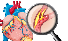 Chớ chủ quan với bệnh xơ vữa động mạch vành