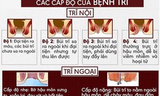 Những dấu hiệu nhận biết điển hình của bệnh trĩ