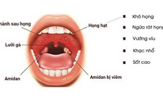 Giải pháp hỗ trợ hiệu quả cho người mắc viêm họng hạt