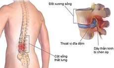 Giải pháp dành cho người mắc bệnh xương khớp