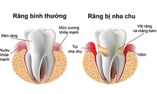 Bệnh viêm nha chu ở người mắc bệnh đái tháo đường