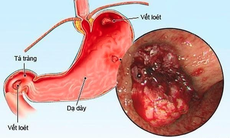 Sống bận rộn, viêm loét dạ dày - tá tràng tăng