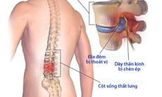 Hậu quả và các biến chứng của bệnh thoái hóa cột sống lưng và cột sống cổ