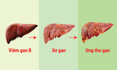 Ngăn chặn “kẻ giết người thầm lặng” viêm gan virus, xơ gan