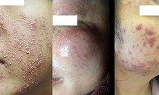 Điều trị da nhiễm Corticoid với  bác sĩ chuyên khoa Da liễu