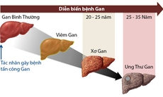 Những điều cần biết để có lá gan khỏe mạnh