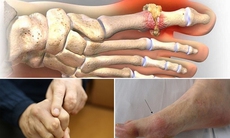 Bệnh gout trẻ hóa, hậu quả khôn lường nếu không xử lý kịp thời