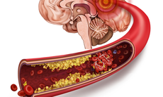 Xơ vữa mạch máu: Cảnh giác với đột quỵ đến bất kỳ lúc nào