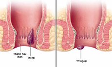 Bệnh trĩ là gì? Dấu hiệu, nguyên nhân và cách khắc phục?