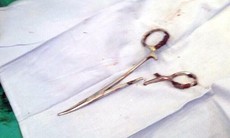 Phẫu thuật thành công lấy panh nằm trong bụng bệnh nhân 18 năm