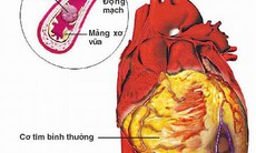 Stent thế hệ mới cho bệnh nhân mạch vành