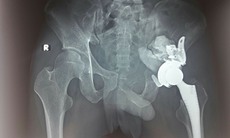 Đau khớp háng không rõ nguyên nhân, nam bệnh nhân bị u ổ cối xương chậu hiếm gặp